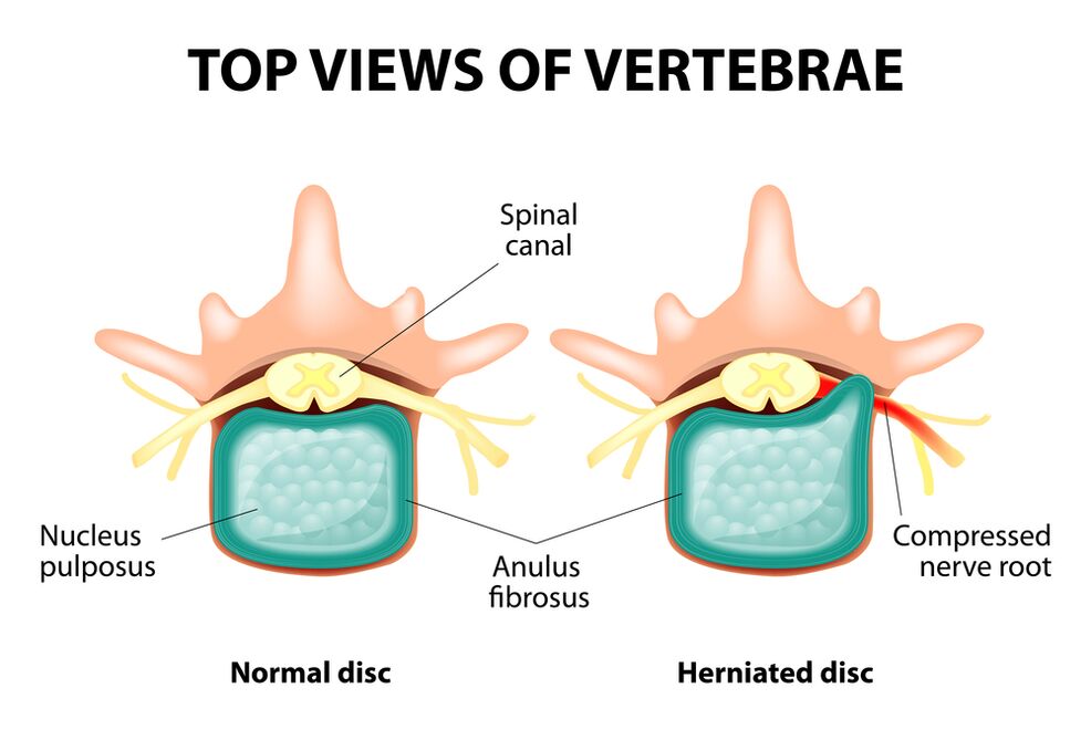 Disco intervertebral saludable y hernia