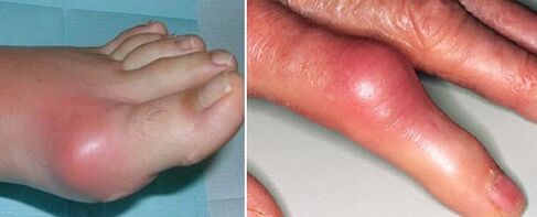 aparición de articulaciones artríticas