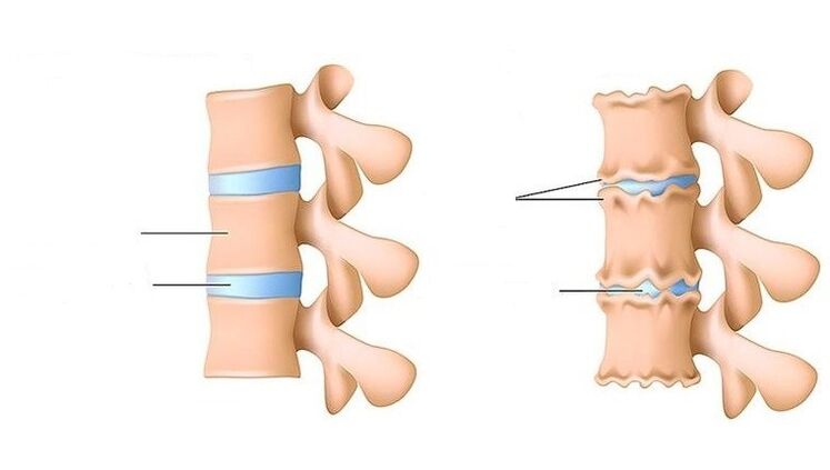 columna vertebral sana y columna afectada por osteocondrosis