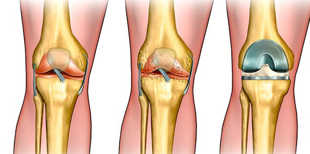 En la tercera etapa de la artrosis se requiere reemplazo de rodilla.
