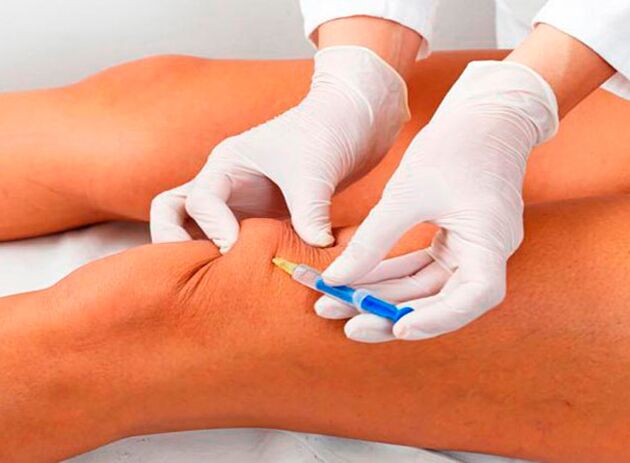 Inyecciones intraarticulares de medicamentos para la osteoartritis de la articulación de la rodilla.