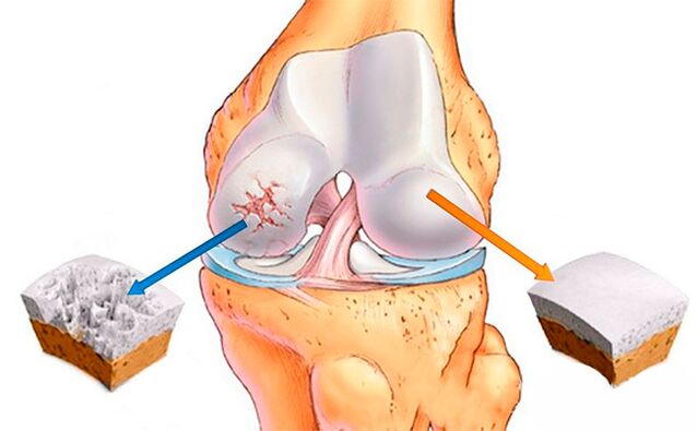Una articulación de rodilla normal (derecha) y otra afectada por artrosis (izquierda)